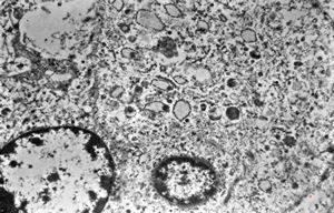 M, 62y. | angiomatous tumor, v.s. Kaposi sarcoma